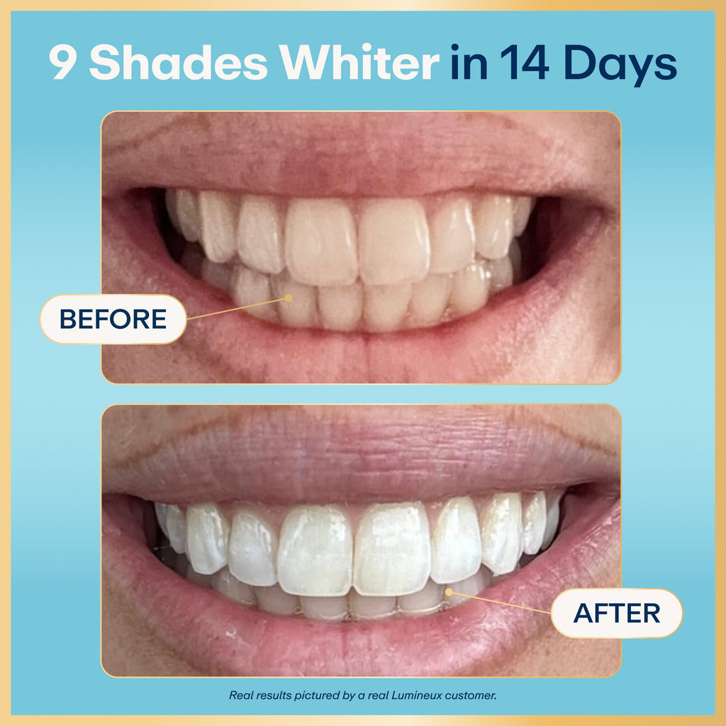 Lumineux® Super Pack Teeth Whitening Strips (21 Treatments)